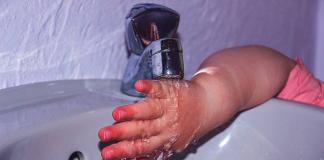 Химический ожог кожи: лечение в домашних условиях