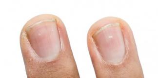 Почему появились белые пятна на ногтях?