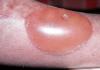 Restoring skin after burns: creams, ointments, folk remedies How to restore skin color after a burn